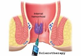 Piles Injection