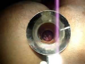 proctoscopy