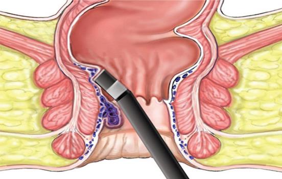 What are the treatment of Piles ?